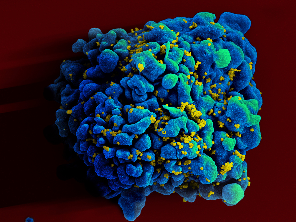 An Electron Microscope Image Of A T-Cell Infected By HIV. The Cell Is A Large Blue And Green Mass Covered In Yellow Dots Set On A Red Background.